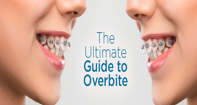 how to fix an overbite