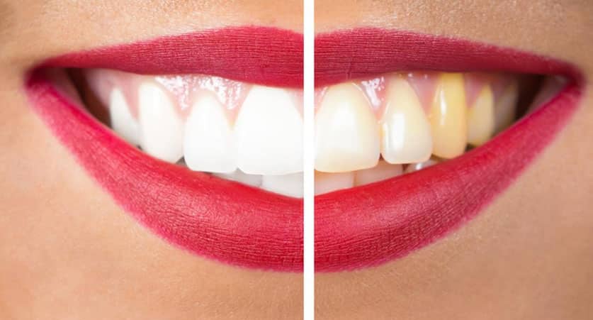 teeth whitening near me