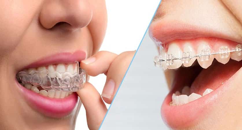 Invisalign Braces