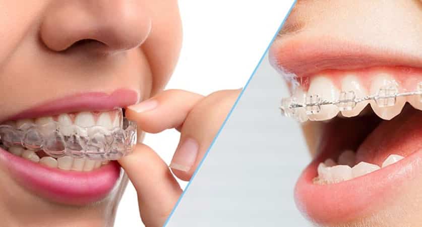 Invisalign Vs Braces