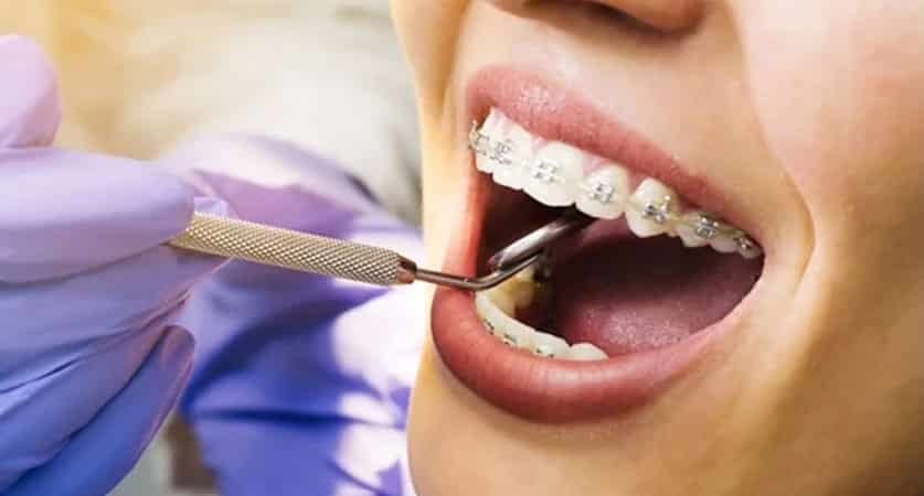 teeth braces near me