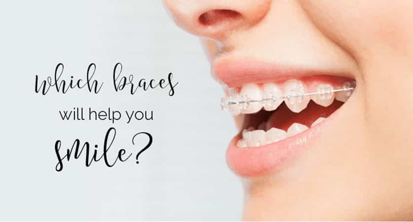 best braces colors