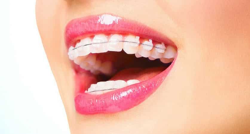 getting braces