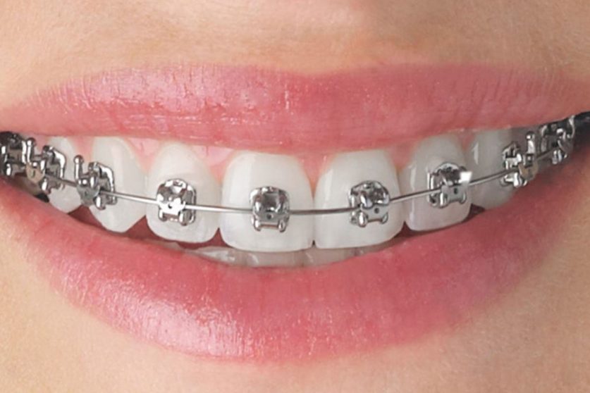 Braces