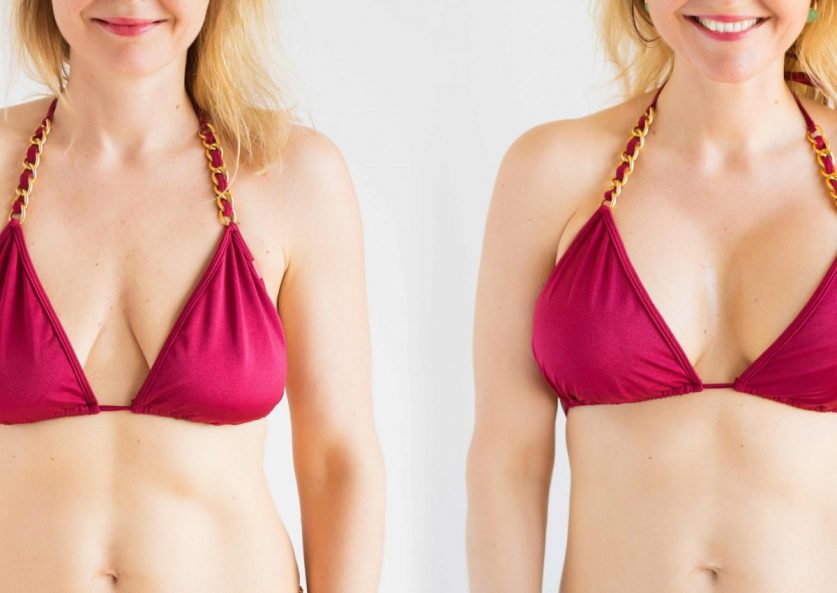 Breast Lift