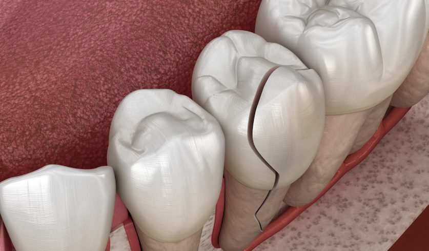 Cracked Tooth