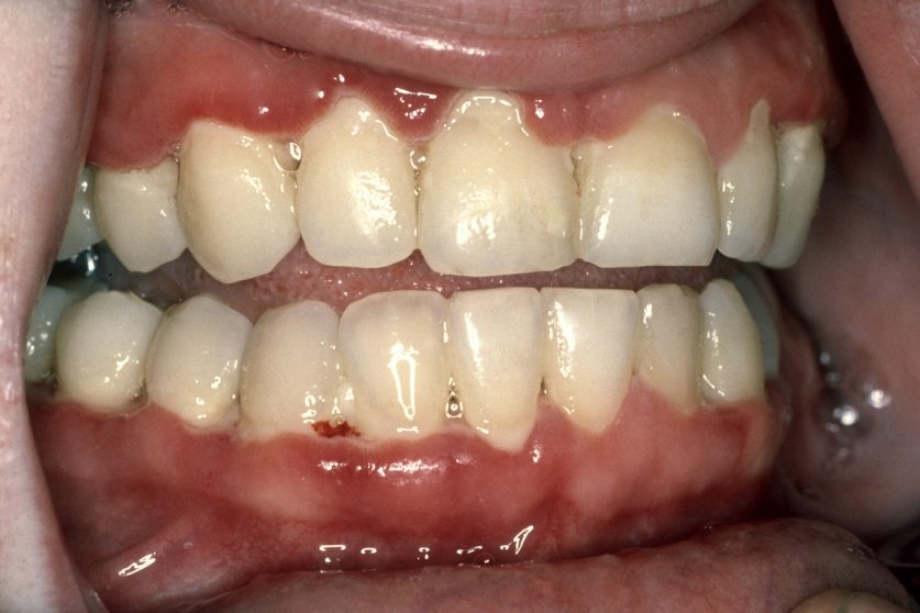 Gingivitis