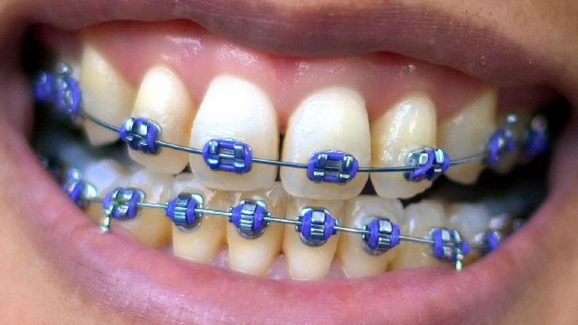 Braces Color