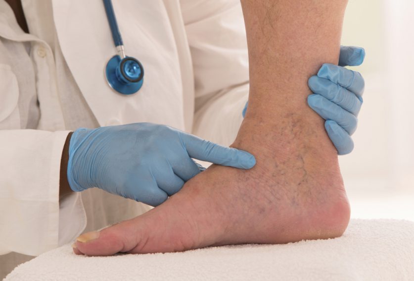 what to expect at a vein clinic