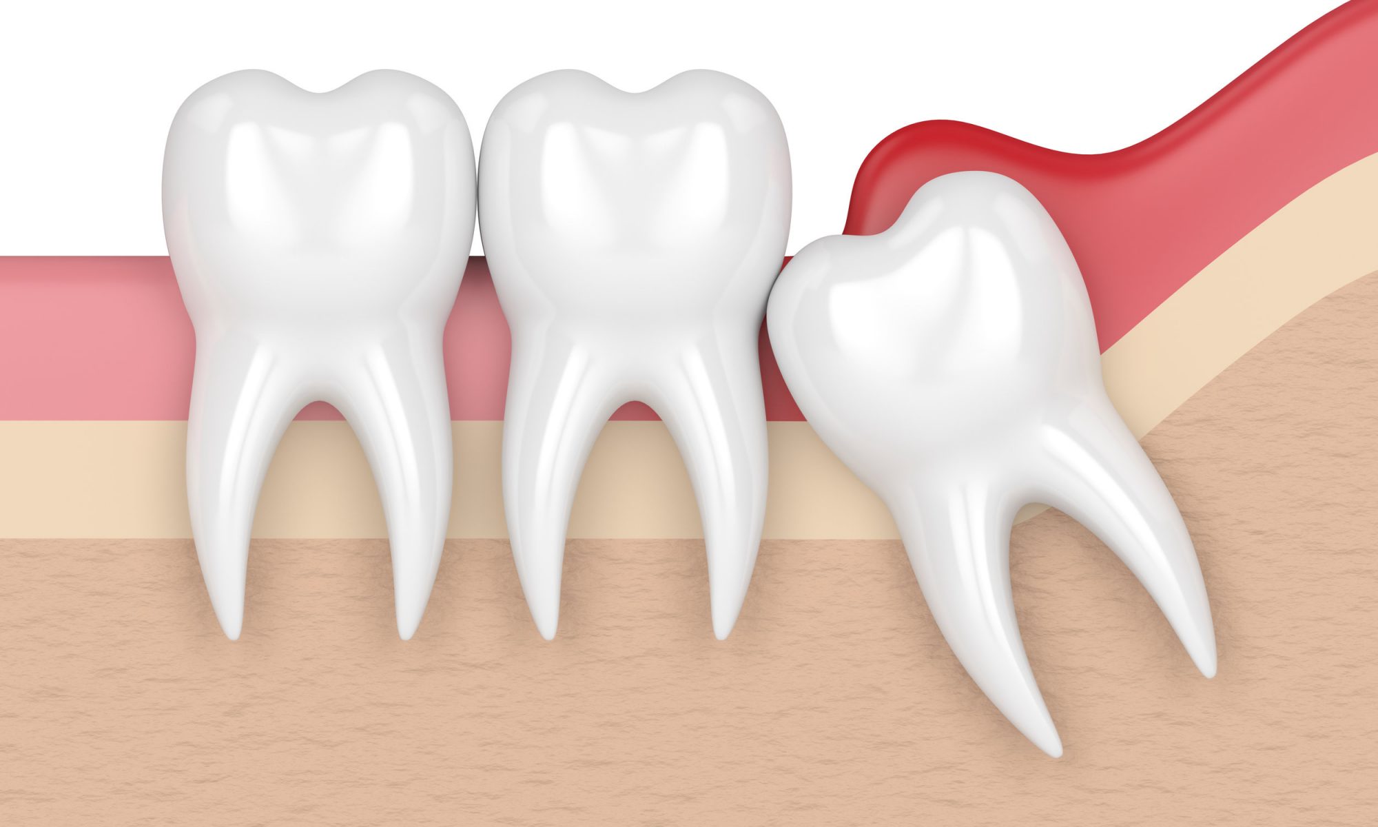 wisdom teeth recovery
