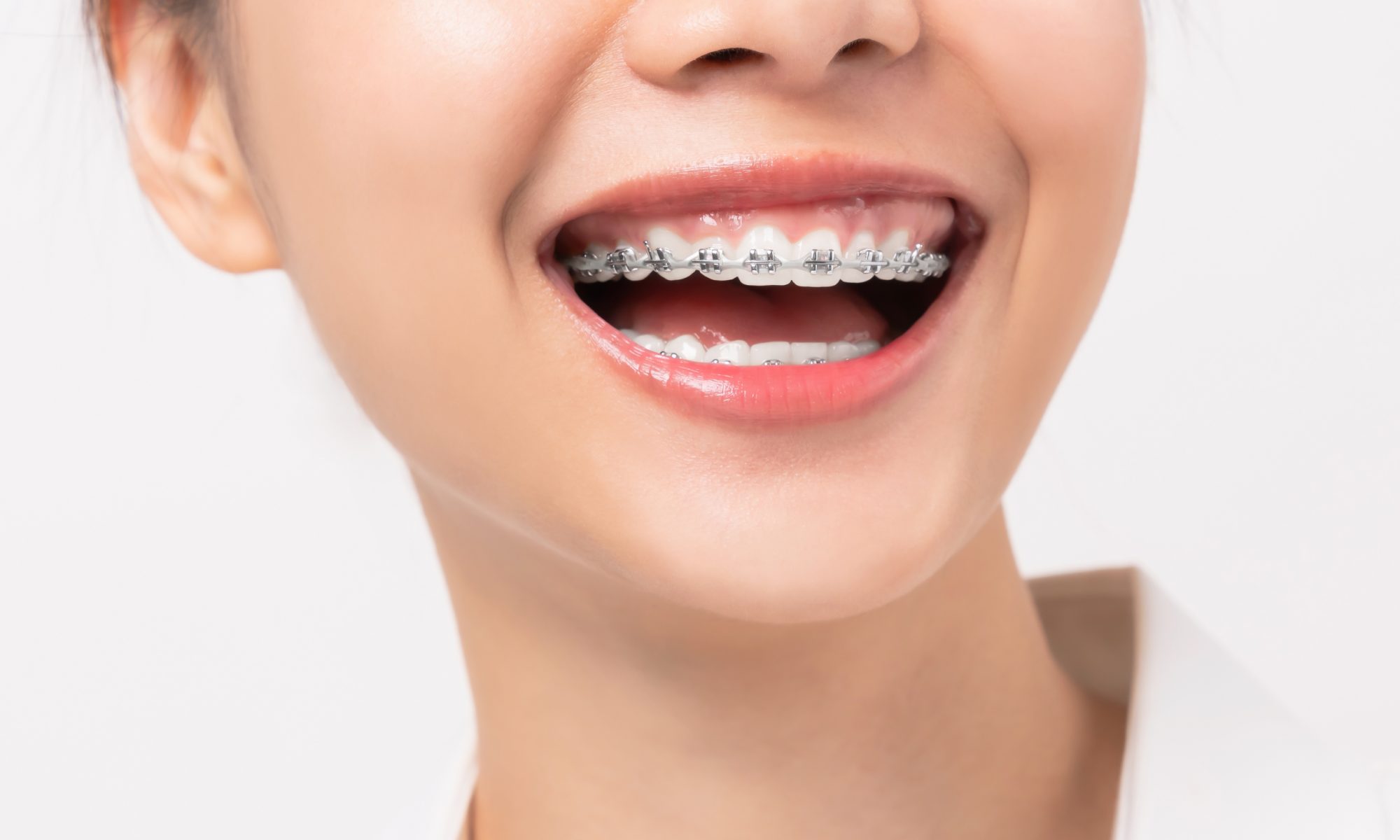 dental insurance for braces