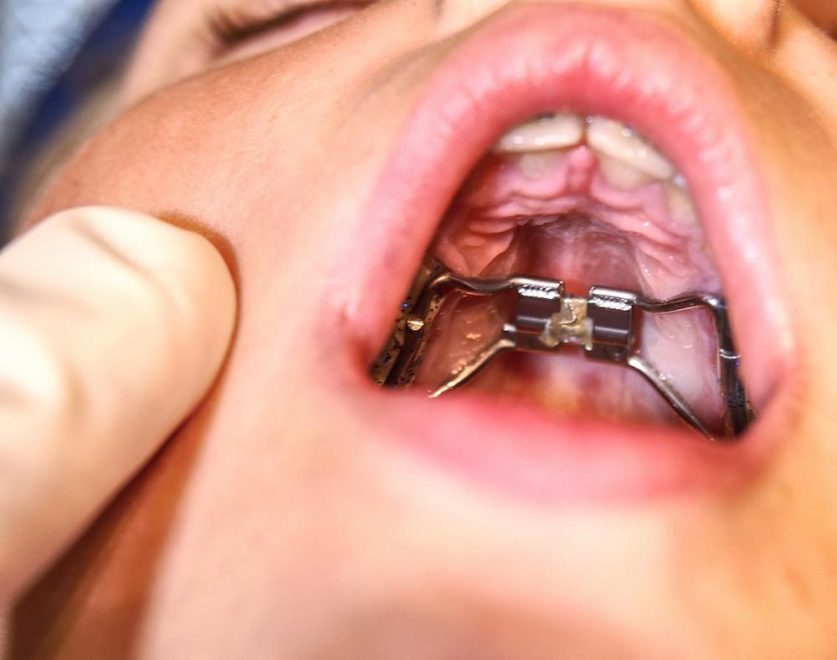 Palatal Expander