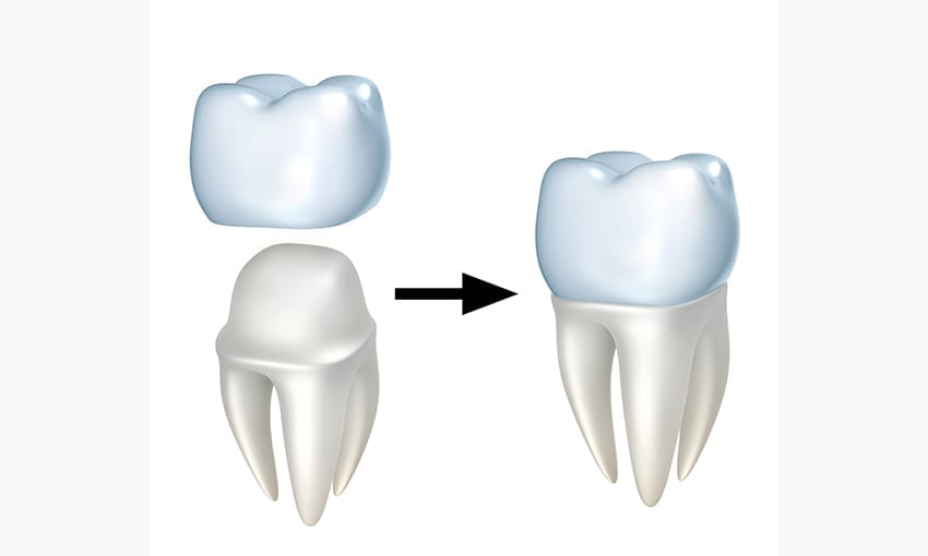 Dental Crowns