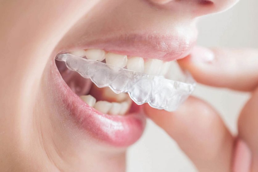 Invisalign clear aligners