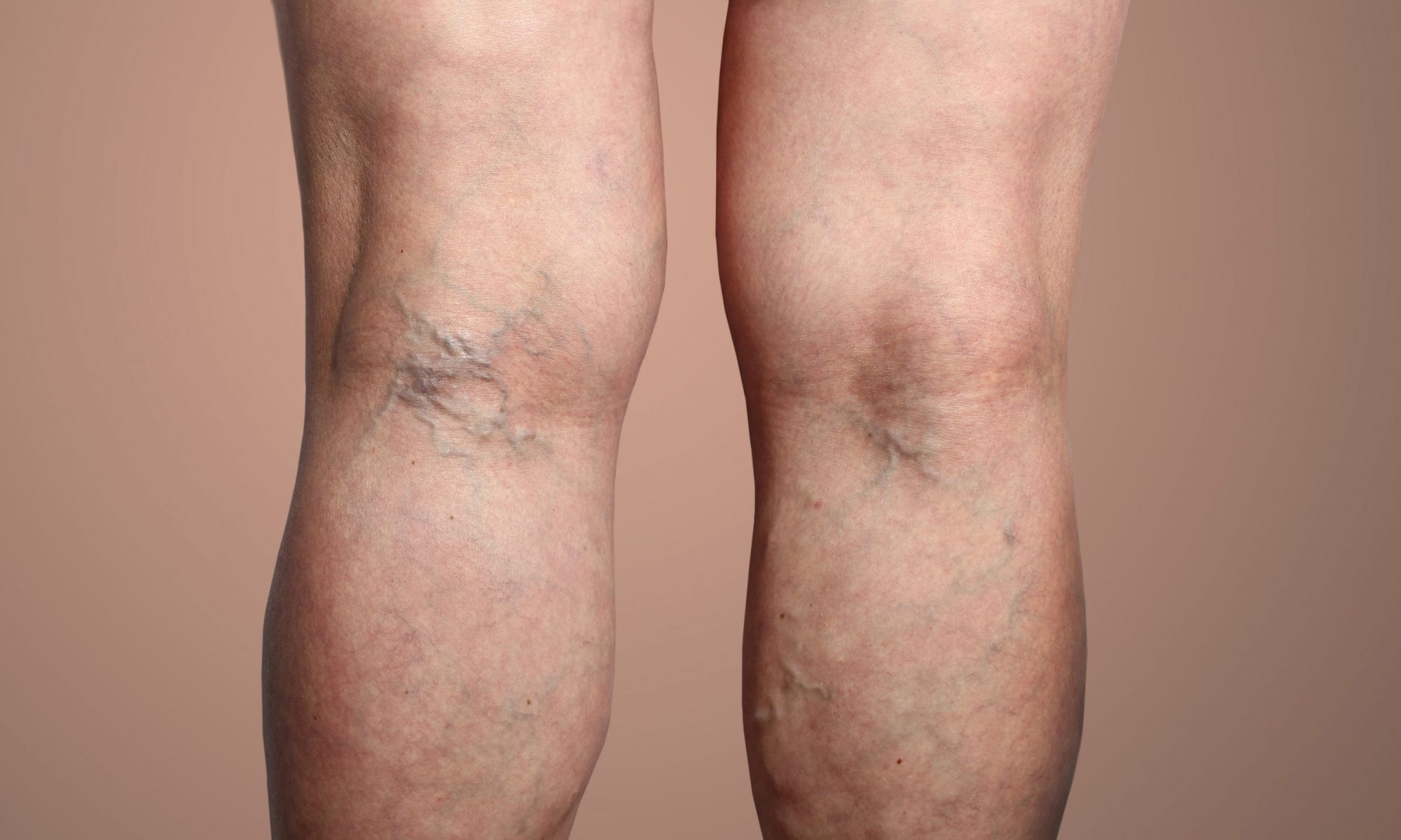 Varicose Veins