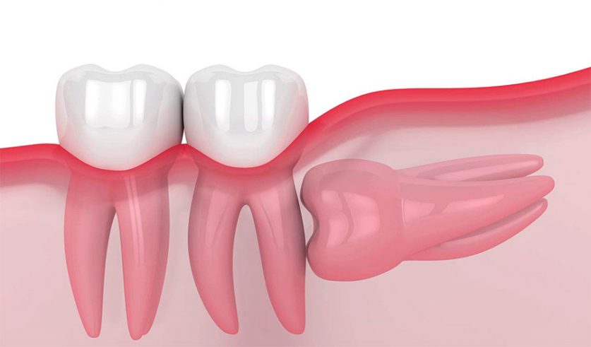 Wisdom Tooth Pain