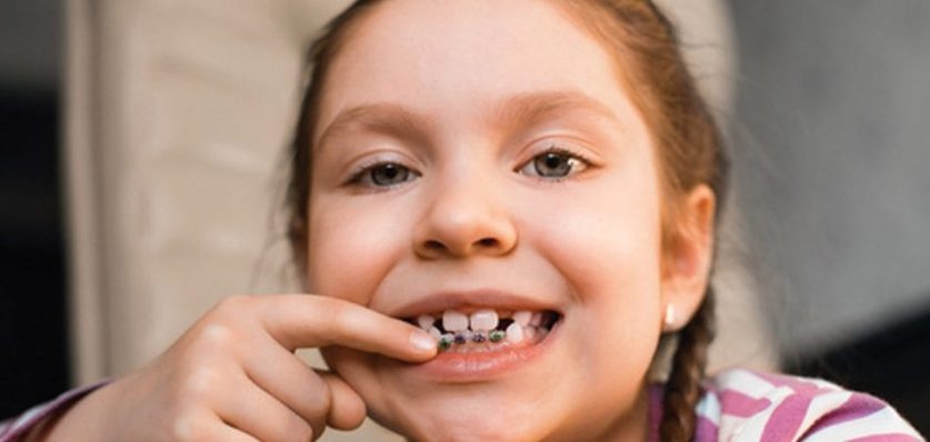 braces with missing teeth