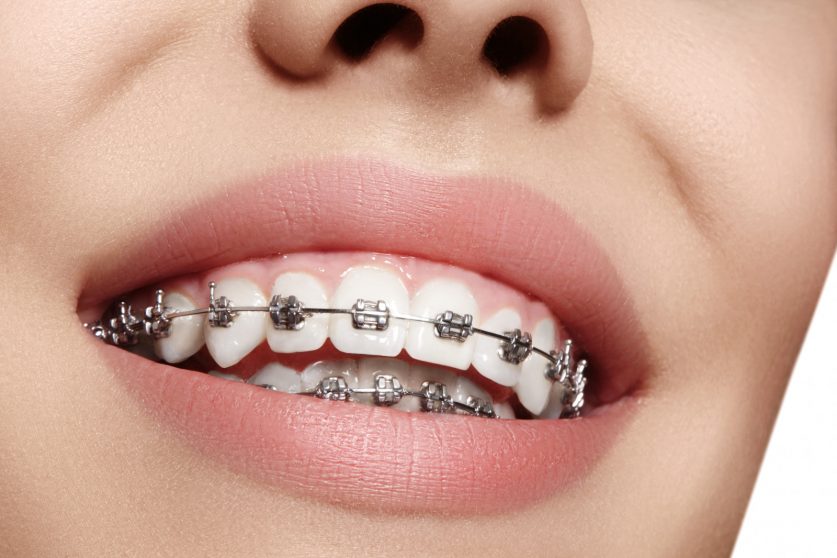 Dental Braces