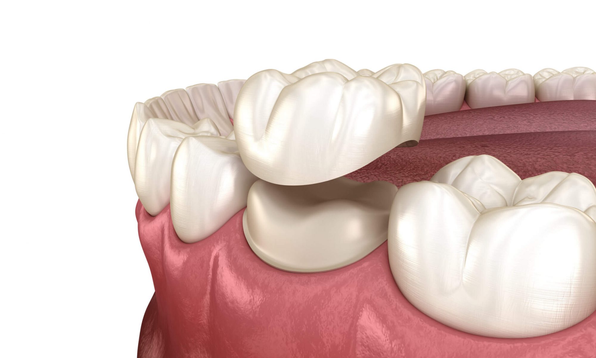 Porcelain Crowns