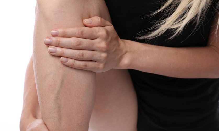 Varicose Veins