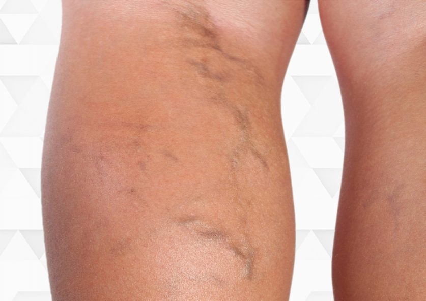 spider veins