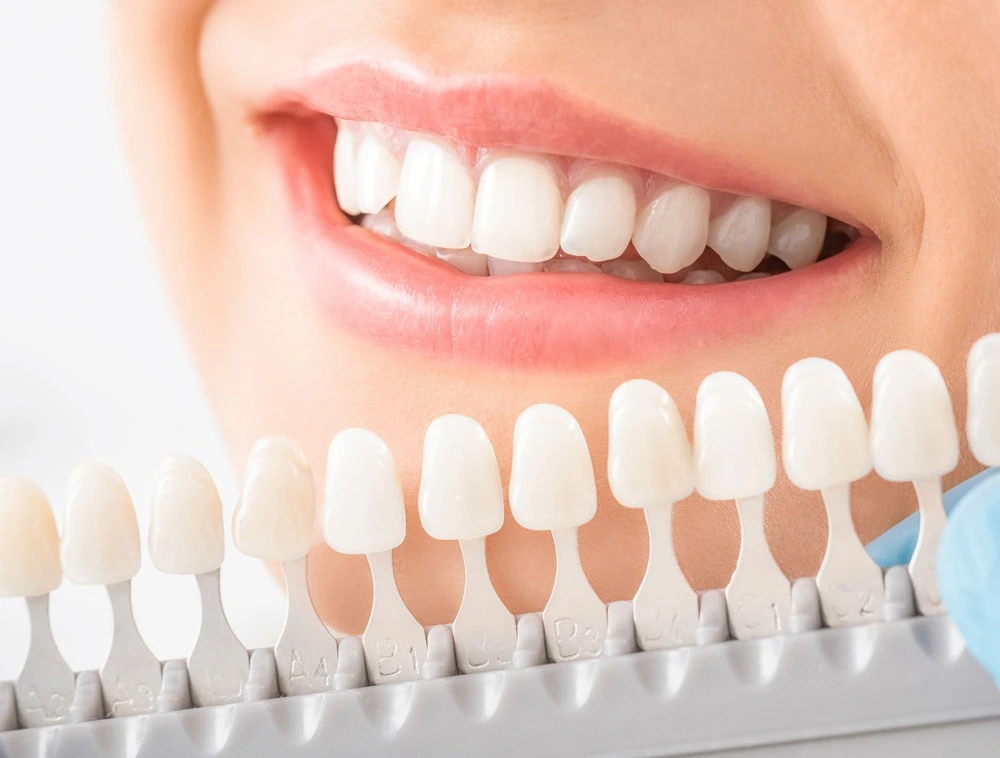 houston texas veneers
